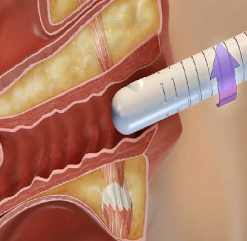 Cistosuspensión y cirugía de Incontinencia