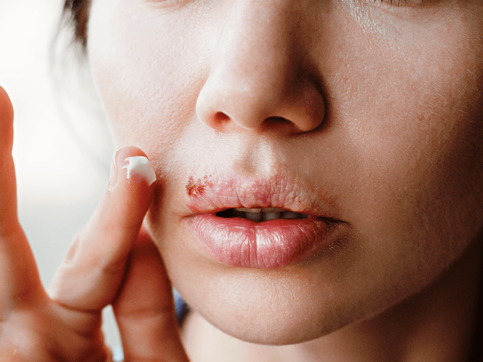 Tratamiento de herpes